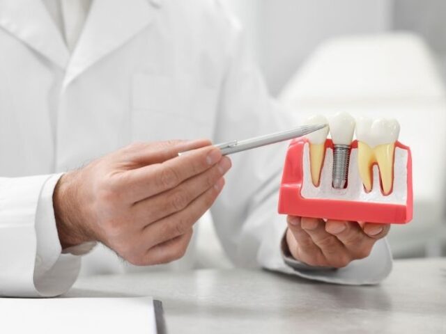 dental implant Diş hekiminin dental implant modeli üzerinde açıklama yapması