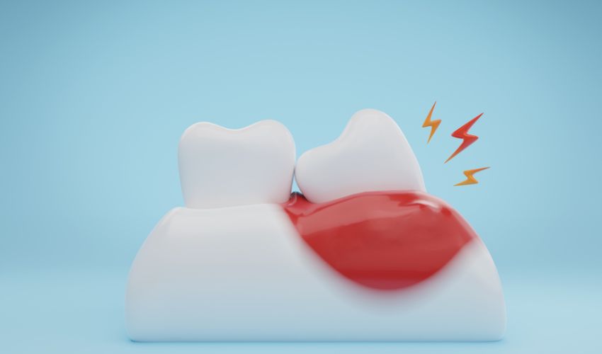 Kırmızı iltihaplı diş eti ve diş hassasiyetini gösteren 3D diş modeli.