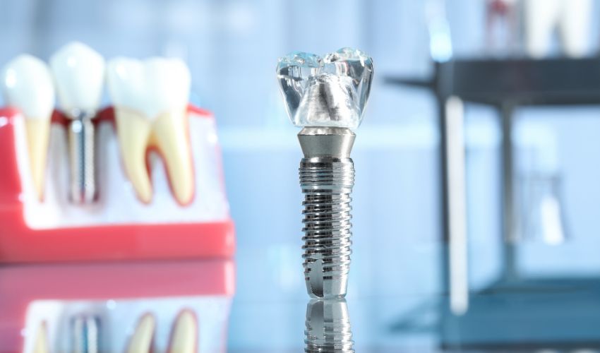 Titanyum ve zirkonyumdan yapılmış diş implantı örneği