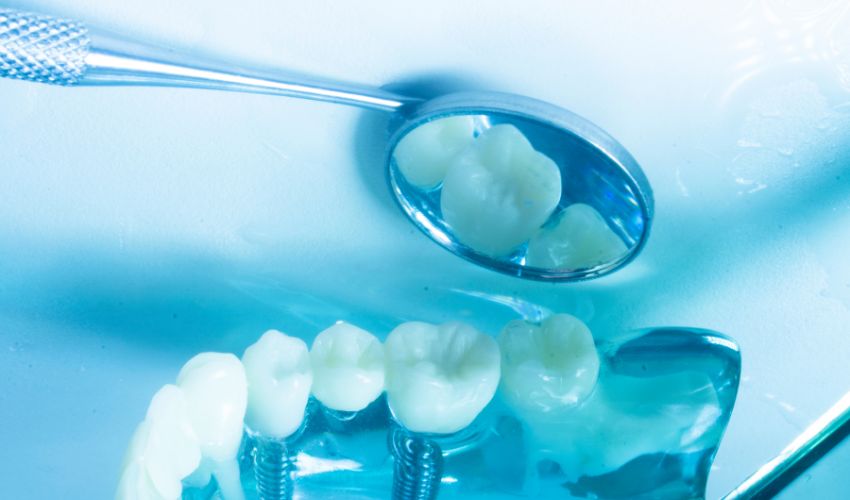 Diş implantlarının ömrü ve uzun vadeli kullanım için bakım önerileri.
