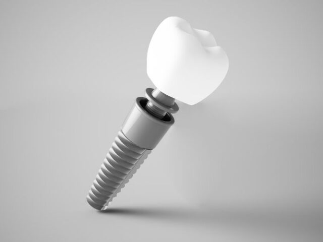diş implantı nedir Titanyum vida ve porselen kaplama ile oluşturulmuş diş implantı modeli.