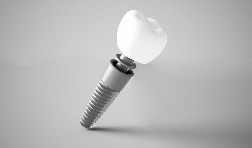 Titanyum vida ve porselen kaplama ile oluşturulmuş diş implantı modeli.