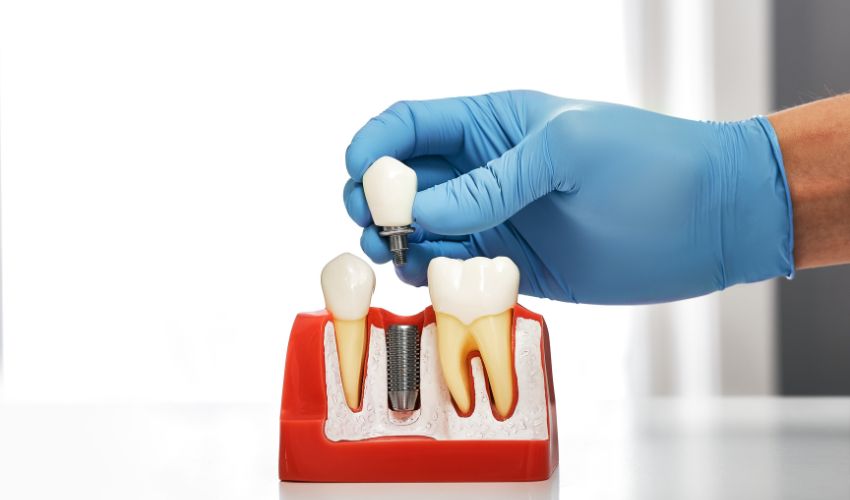 Diş modeli üzerinde gösterilen dental implant uygulaması, implantın çene kemiğine yerleştirilmesini simgeliyor.