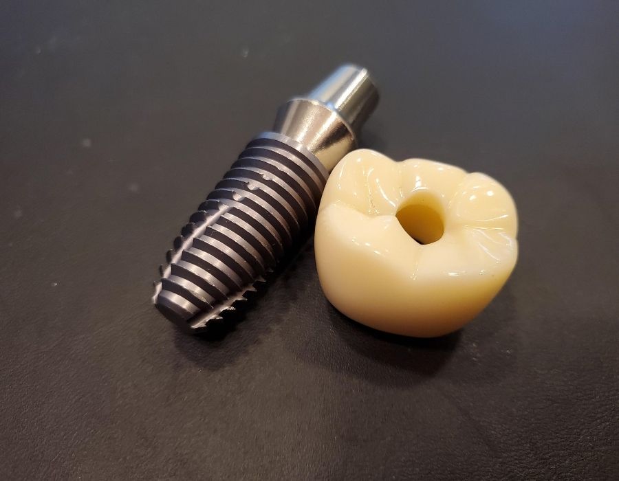 Günümüzde eksik diş tedavisinde en çok tercih edilen yöntemlerden biri olan diş implantları, sürekli gelişen teknolojiyle birlikte yeni materyallerle karşımıza çıkıyor. Bu yeniliklerden biri de son yıllarda estetik ve biyouyumluluk açısından öne çıkan zirkonyum implantlardır.